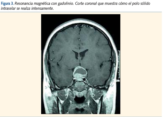 Figura 3. Resonancia magnética con gadolinio. Corte coronal que muestra cómo el polo sólido
intraselar se realza intensamente.